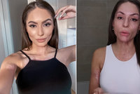 Odvážná Týnuš Třešničková: Popálená youtuberka odhalila vše bez závanu make-upu! A jizvy?